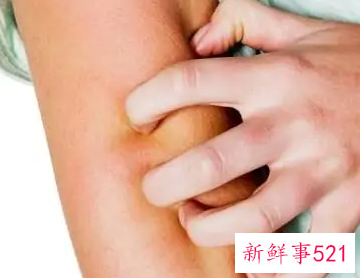 出汗身上就痒是怎么回事