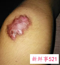 摔伤后疤痕变黑了还能退掉不