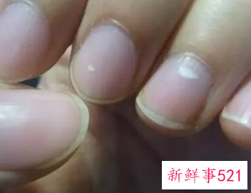 手指甲有白点是什么原因引起的