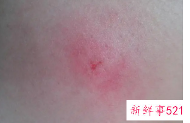 什么虫子咬了会死人