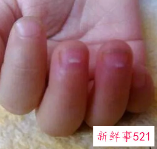 手指甲有白点是什么原因引起的