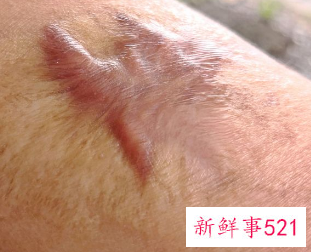 摔伤后疤痕变黑了还能退掉不