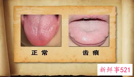 齿痕舌吃什么效果最快的