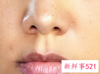 眼周的色斑怎样祛除