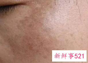 眼周的色斑怎样祛除