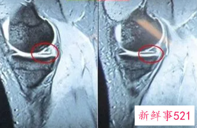 半月板损伤民间老偏方