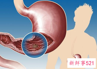 胃癌导致原因有哪些