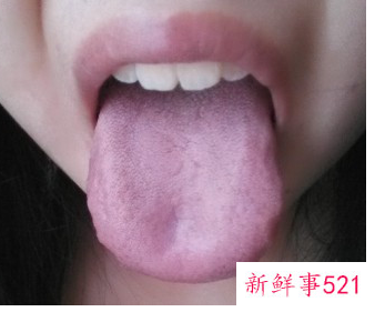 齿痕舌吃什么效果最快的