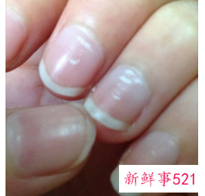 手指甲有白点是什么原因引起的