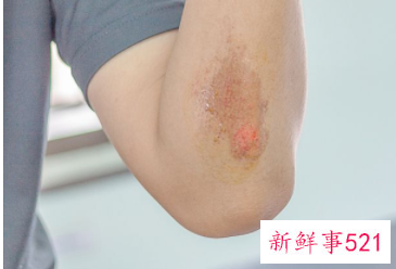 出汗身上就痒是怎么回事