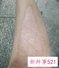摔伤后疤痕变黑了还能退掉不