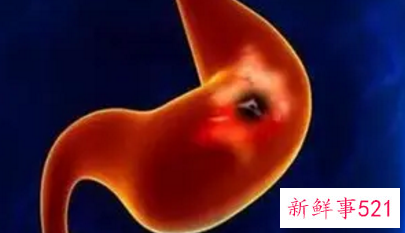 胃癌导致原因有哪些