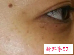 眼周的色斑怎样祛除