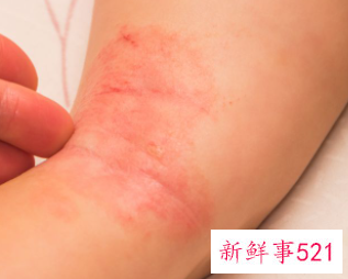 什么虫子咬了会死人