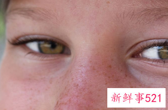眼周的色斑怎样祛除