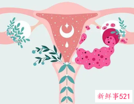盆腔积液怎么治疗才能彻底
