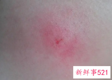 被虫咬了刺痛持续很久