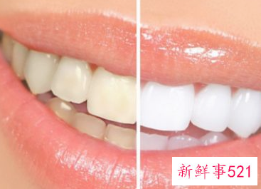 什么可以美容牙齿