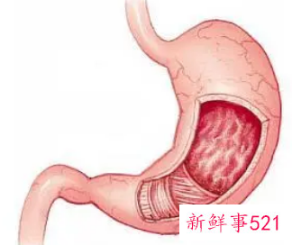急性肠胃炎能自愈吗