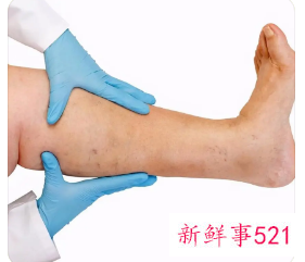 走路走多了全身水肿
