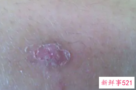 被蚊子咬3年了有硬块
