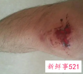 摔倒了膝盖摔肿了又痛怎么办