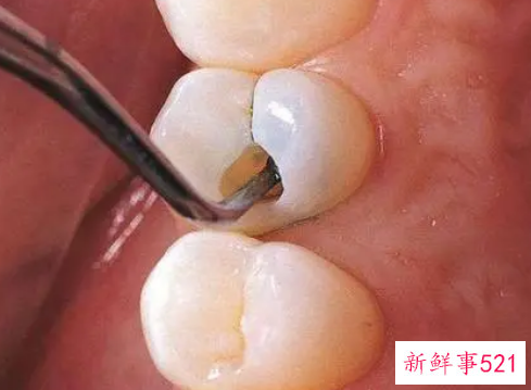 牙痛怎样快速止痛方法