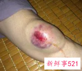 摔倒了膝盖摔肿了又痛怎么办