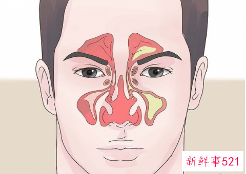 鼻窦炎鼻子堵塞怎么办