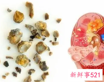 右肾结石怎么排出来