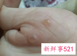 湿气重手指水泡怎么办