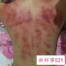 女性背部刮痧的好处