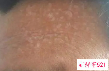 额头爱出汗是怎么回事