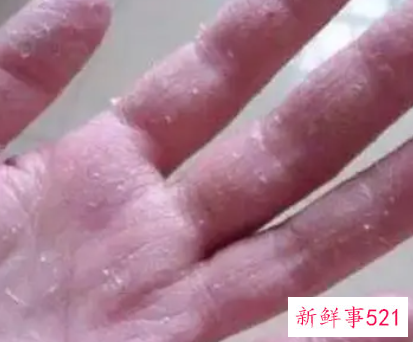 手指掉皮脱皮是怎么回事