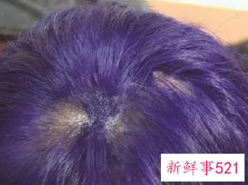 染发会引起脱发吗