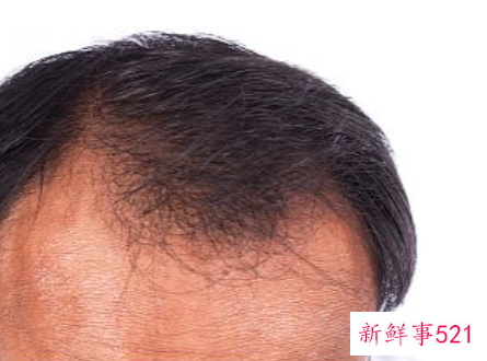 怎样让头发毛囊再生