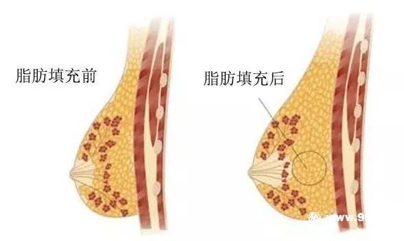 隆胸隆哪里?你真的分得清真假胸吗?