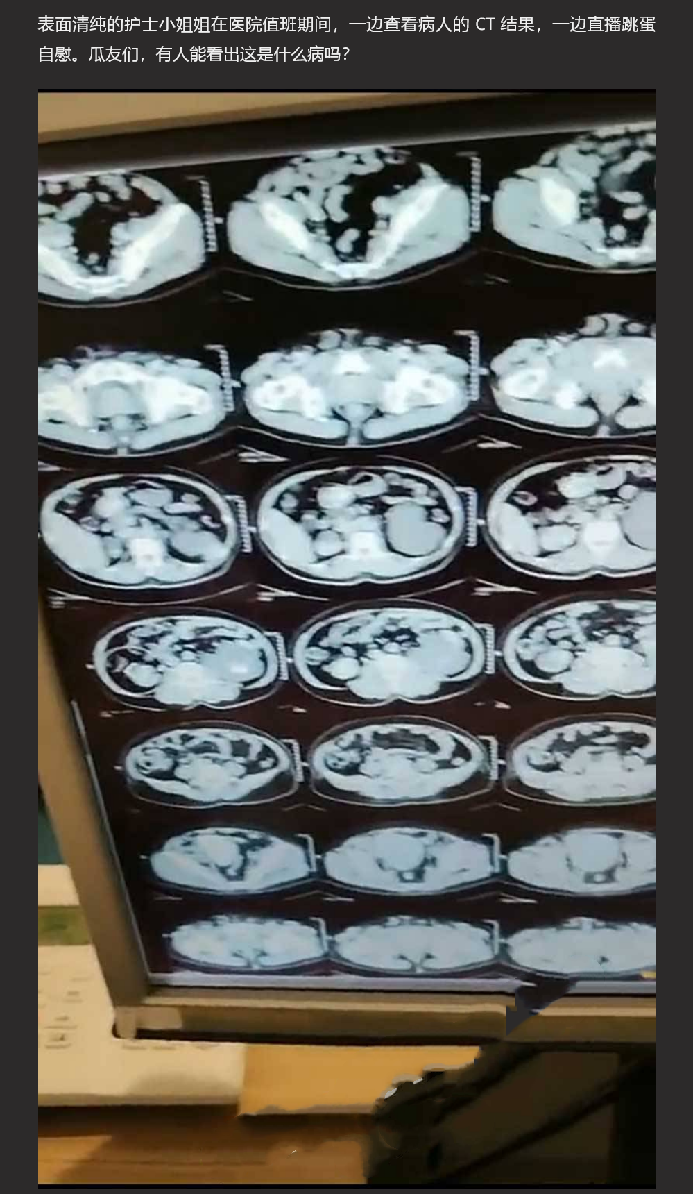 北京某三甲医院反差小护士 值班期间一边看 CT 一边直播自慰到潮吹